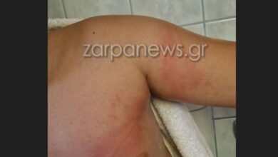 Χανιά:-11χρονος-τσιμπήθηκε-από-θαλάσσια-ανεμώνη-και-γέμισε-με-εξανθήματα