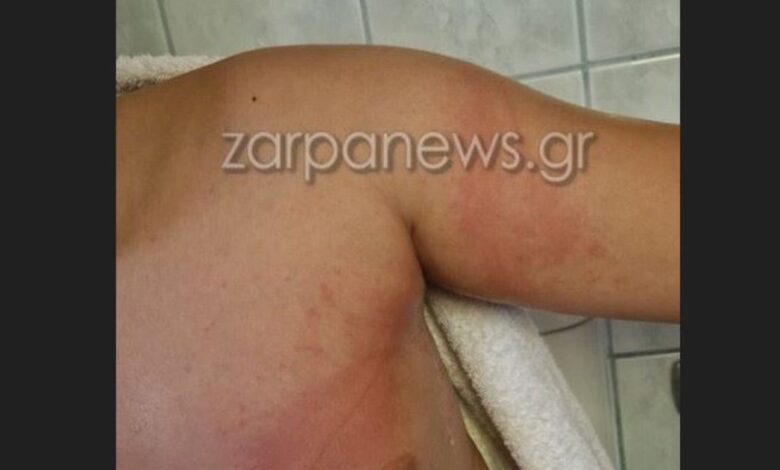 Χανιά:-11χρονος-τσιμπήθηκε-από-θαλάσσια-ανεμώνη-και-γέμισε-με-εξανθήματα