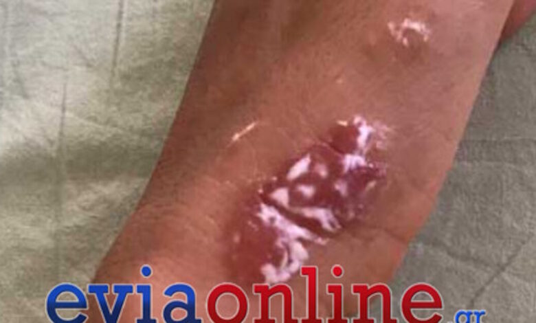 Εύβοια:-Επέλαση-από-μωβ-μέδουσες-–-Φωτογραφίες-από-τις-πληγές-που-προκάλεσαν-σε-κολυμβητές