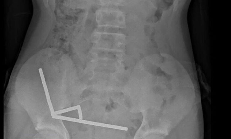 Νέα-Ζηλανδία:-Γιατροί-αφαίρεσαν-δεκάδες-μαγνήτες-από-έντερο-13χρονου