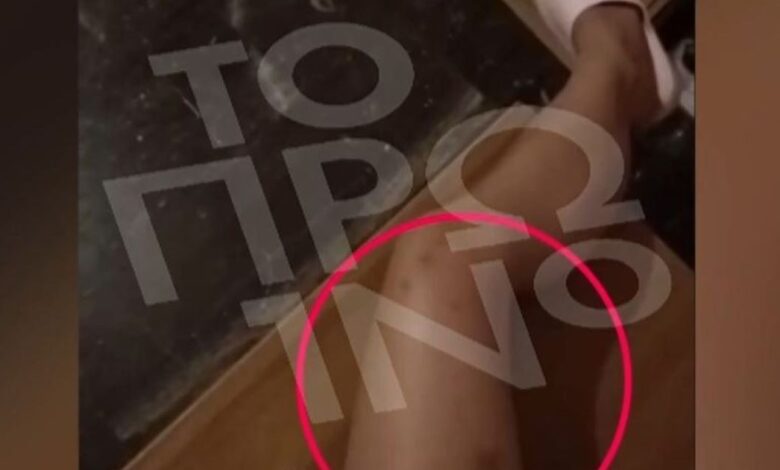 19χρονη-καταγγέλλει-τον-25χρονο-πρώην-σύντροφό-της-για-ξυλοδαρμό-–-«Γιατί-με-χτύπησες,-πονάω»