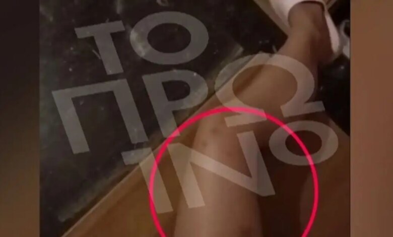 19χρονη-καταγγέλλει-τον-25χρονο-πρώην-σύντροφό-της-για-ξυλοδαρμό-–-«Γιατί-με-χτύπησες,-πονάω»