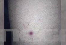 Αίγιο:-Νέες-φωτογραφίες-με-τα-τραύματα-των-παιδιών-–-«Ο-46χρονος-έκρυψε-την-καραμπίνα-και-πήγε-για-ύπνο»