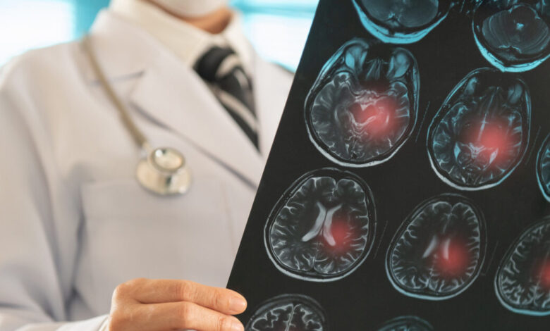 Φάρμακο-βοηθά-στην-μείωση-των-επαναλαμβανόμενων-εγκεφαλικών-επεισοδίων-–-Ο-ρόλος-της-Ελλάδας-στη-μελέτη