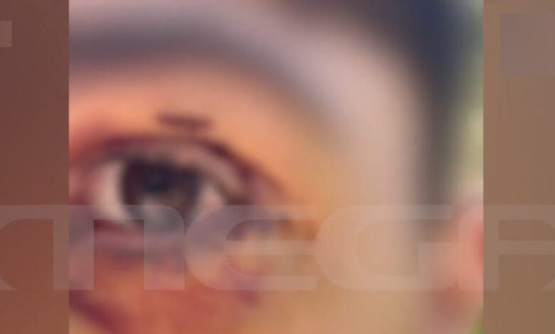 Ιωάννινα:-Άγριος-ξυλοδαρμός-16χρονου-από-ανήλικους-–-«Πήγε-βόλτα-και-κινδύνευσε-να-χάσει-την-όρασή-του»-λέει-η-μητέρα-του