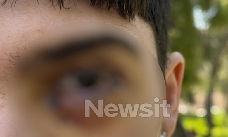 Ξυλοδαρμός-στα-Ιωάννινα:-17-ράμματα-στο-μάτι-έκανε-ο-16χρονος-–-«Τον-χτύπησαν-με-μίσος,-έχει-υποστεί-βλάβη»