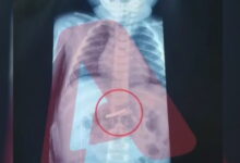 Στο-νοσοκομείο-3χρονο-αγόρι-που-κατάπιε-ξυραφάκι