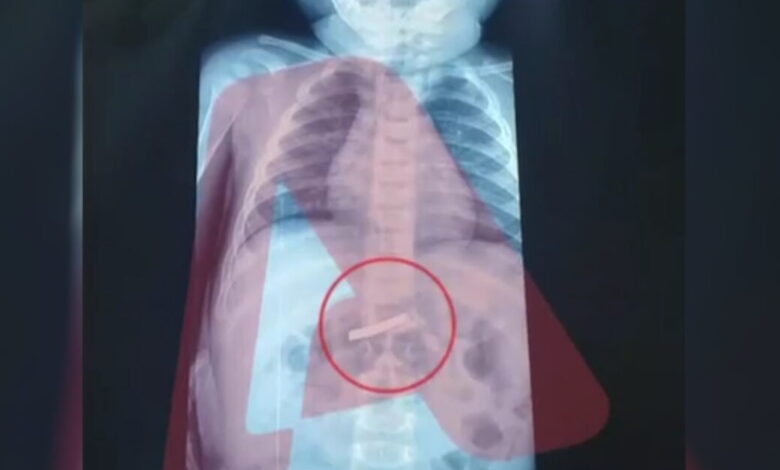 Στο-νοσοκομείο-3χρονο-αγόρι-που-κατάπιε-ξυραφάκι