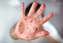 Εκστρατεία-εμβολιασμού,-μετά-τον-θάνατο-100-παιδιών-από-ιλαρά-στο-Μπαγκλαντές