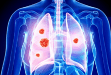 Άνοδος-καρκίνων-του-αίματος-μετά-από-θεραπεία-διαφορετικού-καρκίνου-–-Τι-αποκαλύπτει-νέα-μελέτη