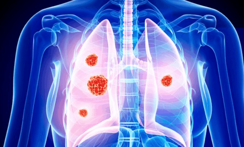 Άνοδος-καρκίνων-του-αίματος-μετά-από-θεραπεία-διαφορετικού-καρκίνου-–-Τι-αποκαλύπτει-νέα-μελέτη